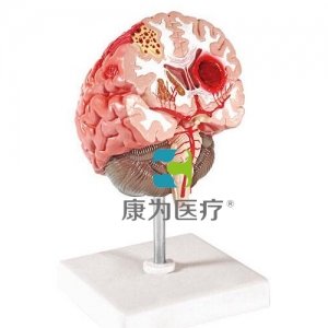 张家港“康为医疗”脑中风模型